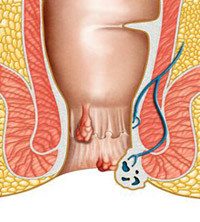  1. Chảy máu: Có hiện tượng chảy máu trực tràng hoặc hậu môn, bệnh càng nặng thì tình trạng này sẽ ngày càng nặng thêm. Nếu xuất hiện tình trạng đi vệ sinh ra máu, cần tiến hành kiểm tra trực tràng hậu môn ngay dưới sự hướng dẫn của bác sỹ .