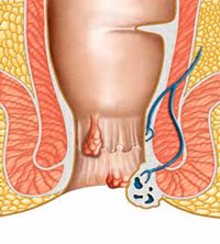  1. Chảy máu: Có hiện tượng chảy máu trực tràng hoặc hậu môn, bệnh càng nặng thì tình trạng này sẽ ngày càng nặng thêm. Nếu xuất hiện tình trạng đi vệ sinh ra máu, cần tiến hành kiểm tra trực tràng hậu môn ngay dưới sự hướng dẫn của bác sỹ .