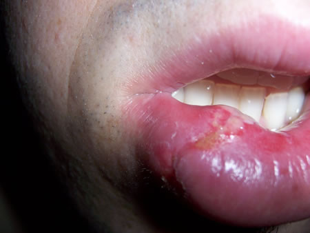 2. U bướu trên môi hoặc miệng gây đau đớn và không thể chữa lành một cách nhanh chóng có thể là triệu chứng ung thư. Thậm chí nếu khối u xuất hiện trong cổ họng, bạn cần chú ý đến ung thư miệng.