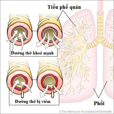 Viêm phổi, viêm phế quản, viêm xoang và viêm tai là những ví dụ của các biến chứng liên quan đến cúm, theo Trung tâm kiểm soát và phòng ngừa dịch bệnh.