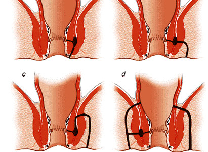  5. Tuyến hạch phình to: Tuyến hạch xung quanh hậu môn hoặc quanh bẹn bỗng dưng nổi to. Tốt nhất bạn nên tiến hành chụp CT để xem có phải là di căn ung thư không.