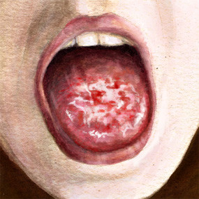 Hỗn hợp vết loét màu đỏ và trắng trong miệng gọi là erythroleukoplakia, do sự tăng trưởng tế bào bất thường có nhiều khả năng trở thành ung thư. Hiệp hội Nha khoa Mỹ khuyến cáo bạn cần kiểm tra sớm nếu vết loét trên 2 tuần. Trong giai đoạn sớm, ung thư miệng có thể không gây đau.