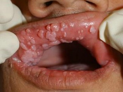 4. Nhiễm vi rút. Vi rút Papilloma ở người (HPV) là một trong những vi rút dẫn đến bệnh ung thư miệng. Vi rút này phát triển tại các cơ sở của lưỡi, lây lan vào khu vực bên trong của má và giữa các răng.