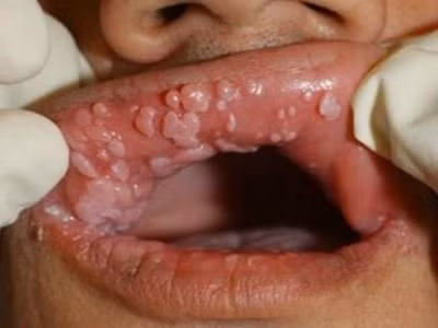 4. Nhiễm vi rút. Vi rút Papilloma ở người (HPV) là một trong những vi rút dẫn đến bệnh ung thư miệng. Vi rút này phát triển tại các cơ sở của lưỡi, lây lan vào khu vực bên trong của má và giữa các răng.