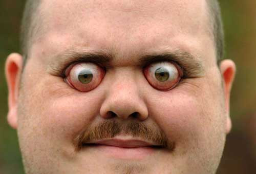 3. Hội chứng biến dạng: mắt bị đẩy lồi, má bị đẩy phồng, rễ mũi bị dãn rộng, mất rãnh mũi-má, cứng hàm... tuỳ theo vị trí và độ lan rộng của khối u.