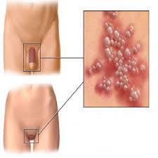 Những người bị nhiễm vi rút u nhú ở người (HPV).