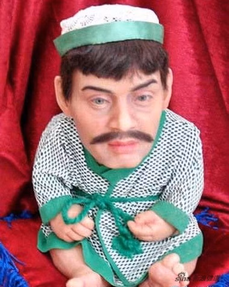 Đây là kết quả của chứng lão hóa sớm ở trẻ em tại Áo. Nó khiến một đứa bé có khuôn mặt của một người đàn ông trung niên.