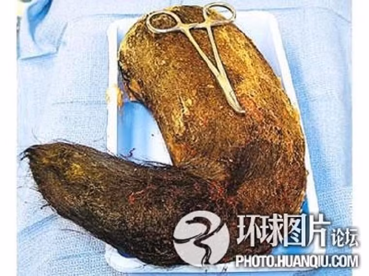 Đây là nguyên trạng một bộ tóc trong dạ dày của một cô gái trẻ thèm nuốt tóc