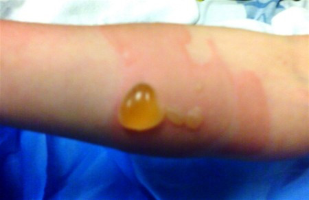  Dùng vật nhọn tự chọc vỡ bóng nước. Hành động này có thể khiến cho vùng da bị tổn thương bên trong dễ bị nhiễm trùng sau khi bóng nước bị vỡ ra.