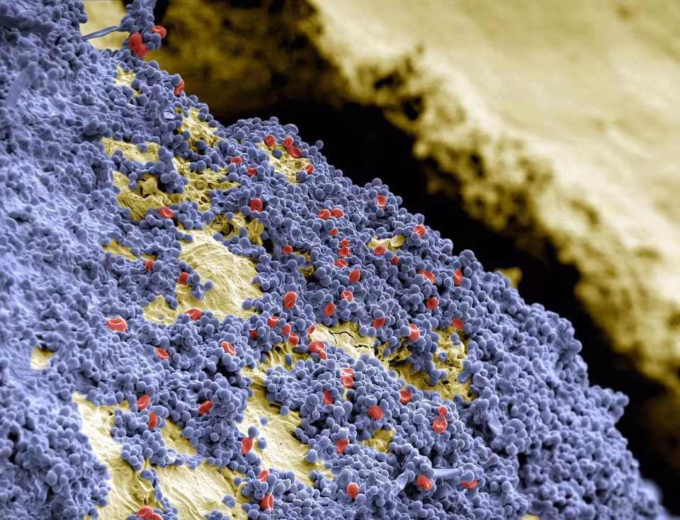 Hình ảnh phóng đại bằng kính hiển vi hiển thị mảng vi khuẩn màu xanh xen lẫn những tế bào màu đỏ bám trên bề mặt răng màu vàng.