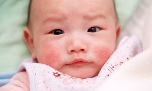 Các biểu hiện thường thấy của dị ứng sữa là có máu trong phân, con cũng bị tiêu chảy và nôn mửa. Nếu bé hay bị nổi mề đay, phát ban xung quanh miệng và cằm, ho, thở khò khè hoặc khó thở cũng có thể là dấu hiệu cho thấy hệ hô hấp của bé bị ảnh hưởng bởi dị ứng sữa. Nếu các triệu chứng này tăng dần hãy nói chuyện với bác sĩ.