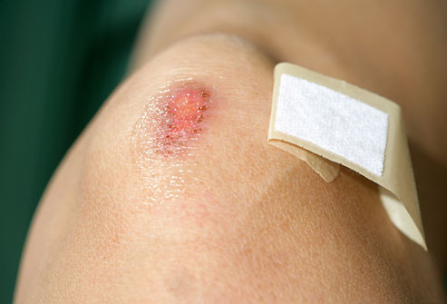 Người chăm sóc bệnh nhân có nguy cơ bị lây nhiễm HIV qua các vết hở rỉ nước khi tiếp xúc trực tiếp với máu và dịch sinh học của người bệnh hoặc bị kim tiêm đâm phải tay, dao kéo cứa phải tay... do tai nạn rủi ro nghề nghiệp.