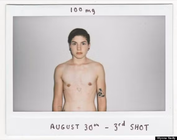 Ảnh chụp ngày 30/8/2013, sau khi Neilly tiêm testosterone lần thứ 3.