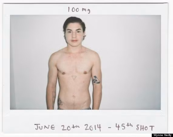 Ngày 20/6/2014, lần tiêm tiêm testosterone thứ 45.