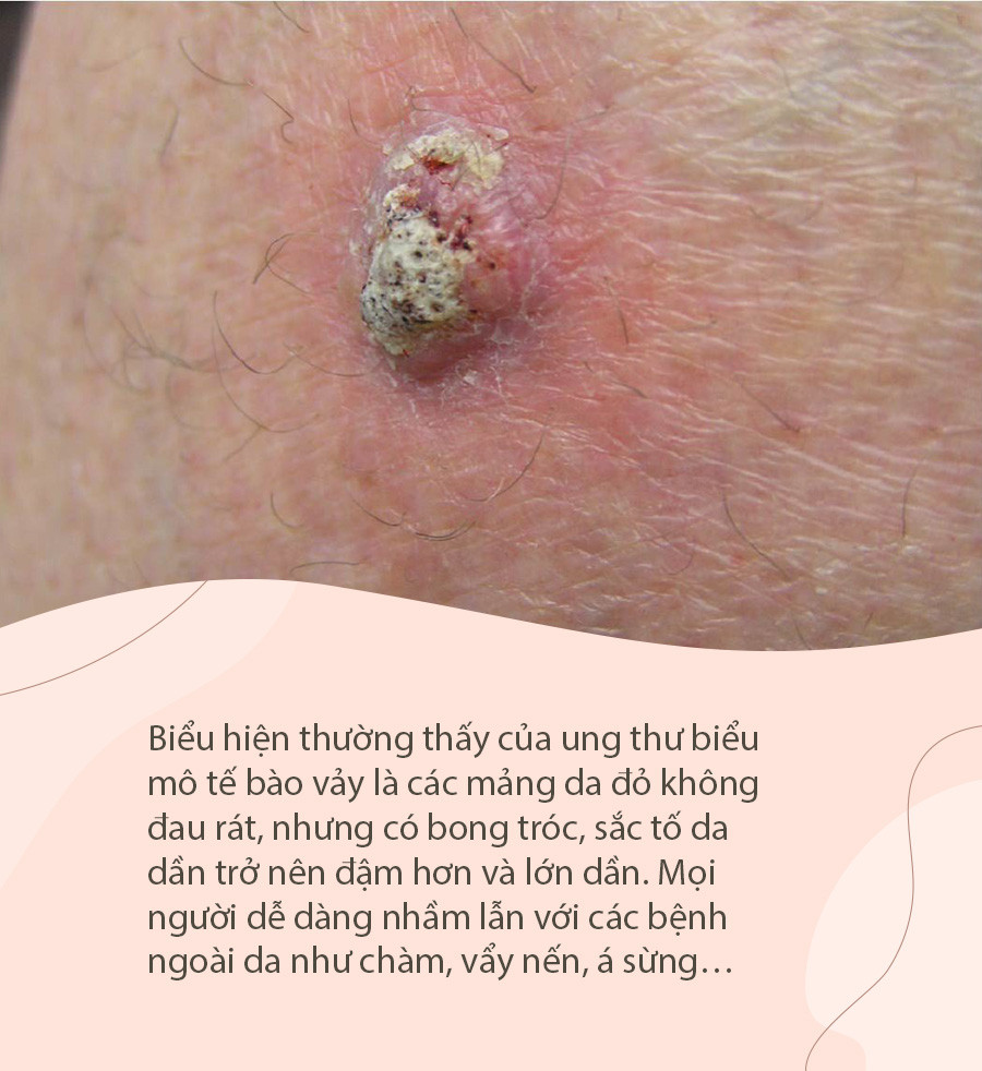 Vet bot do sau 4 thang duoc chan doan ung thu nguy hiem bac nhat-Hinh-2
