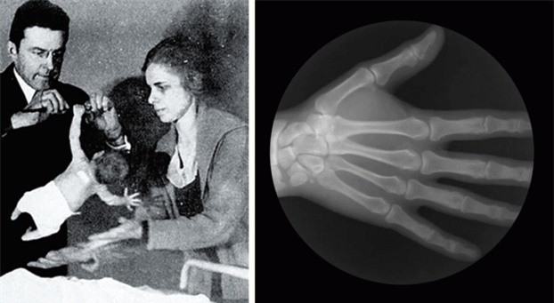 3. Bạn có sức mạnh siêu phàm khi mới đẻ. Trẻ sơ sinh rất khỏe so với kích thước và trong lượng cơ thể. Nếu cho một đứa trẻ nắm thanh ngang, nó có thể đu trên đó một thời gian dài mà không thấy mệt. Phản xạ nắm bắt lòng bàn tay này được thừa hưởng từ tổ tiên của chúng ta khi những con khỉ mới sinh phải ôm lấy mẹ của chúng, nắm lấy tóc của mẹ. Từ 3 tháng tuổi, trẻ sơ sinh thường mất khả năng này.