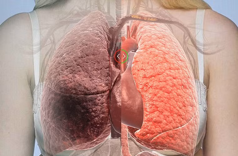 Tỷ lệ sống sót của người mắc ung thư phổi chỉ đạt 17%. Trong khi đó, tỷ lệ sống sót của bệnh nhân ung thư vú đạt tới 90%; tỷ lệ sống sót của bệnh nhân ung thư tiền liệt tuyến đạt 100%.