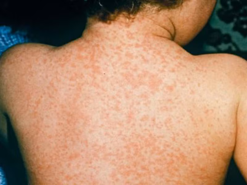 Nếu xuất hiện các vết phát ban màu hơi đậm so với làn da, mịn, bố trí vùng mặt sau cổ hoặc xung quanh cánh tay, bạn dễ đối diện với nguy cơ tiểu đường tuýp 2.