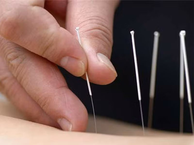  Châm cứu. Trong trường hợp phải chịu những cơn đau đớn kéo dài, mẹ bầu hãy nhờ đến sự giúp đỡ của các bác sĩ bằng việc châm cứu kịp thời. Nhìn chung, cơn đau sẽ giảm đáng kể sau một vài lần thực hiện.