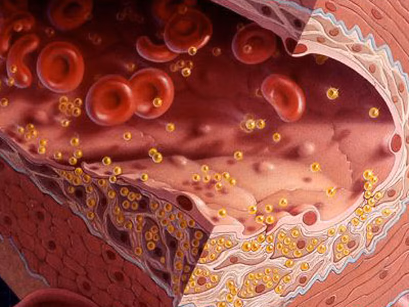 Ngoài ra, những người có bệnh lý về hệ tim mạch như cao huyết áp, mỡ máu cao cũng dễ mắc chứng thiếu máu não.