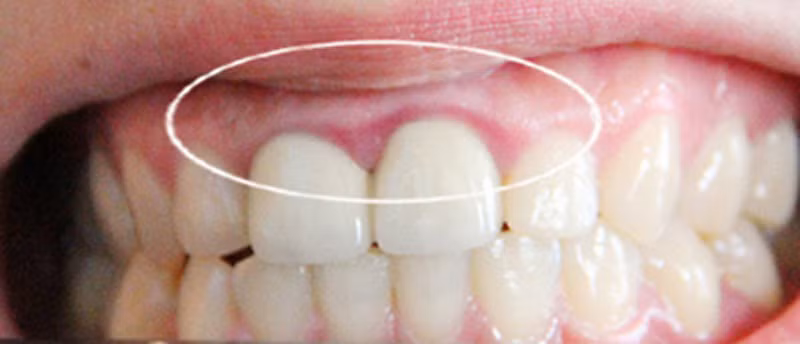 Nướu răng. Chứng nướu răng là một trong những vấn đề dễ xử lý về sức khỏe răng miệng. Dù vậy, nếu không điều trị kịp thời, nó có thể dẫn đến các bệnh nha chu nghiêm trọng hơn như hơi thở hôi, chảy máu, sưng nướu và gãy răng.