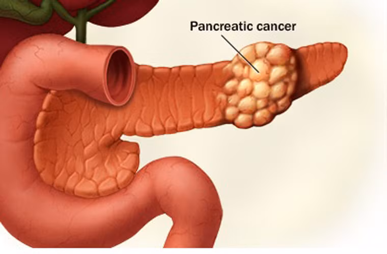 Chủng tộc. Nghiên cứu được thực hiện bởi các nhà khoa học Mỹ chỉ ra, ung thư tuyến tụy phổ biến với người Mỹ gốc Phi hơn là người da trắng. Một trong những lý do được đề xuất là nó có thể bắt nguồn từ điều kiện kinh tế xã hội và thói quen sử dụng thuốc lá ở nhóm người da đen.