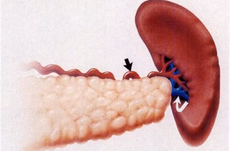 Viêm tụy mãn tính. Mắc chứng viêm tụy làm ảnh hưởng đến chức năng hoạt động của cơ quan này. Về lâu dài, viêm tụy có thể chuyển biến thành ung thư nguy hiểm.