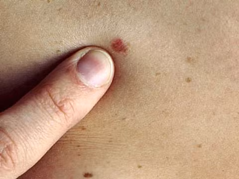 Phụ nữ có nhiều cơ hội vượt qua u ác tính hơn đàn ông.