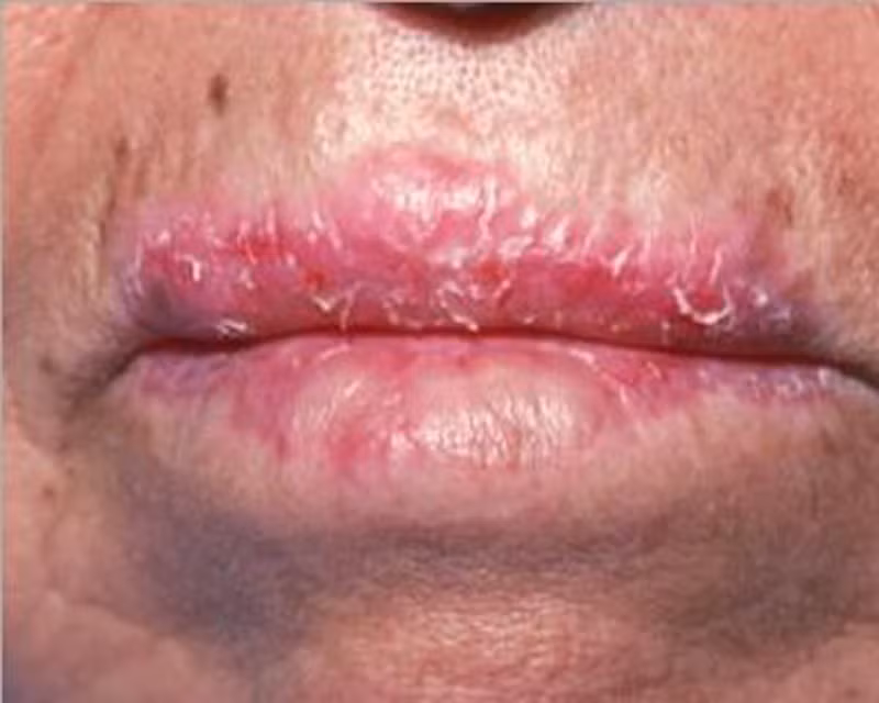 Tuổi tác, yếu tố di truyền. Con số thống kê những trường hợp mắc bệnh cho thấy nam giới, độ tuổi trên bốn mươi và người gốc Phi thường có nguy cơ phát triển bệnh.