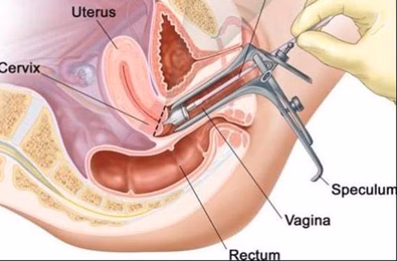Lúc này, dùng gương quan sát thật kỹ khu vực bên trong. Chú ý đến màu sắc của cổ tử cung. Cổ tử cung khỏe mạnh sẽ trơn ướt, hơi hồng trong khi cổ tử cung của phụ nữ mang thai sẽ có màu hơi xanh.