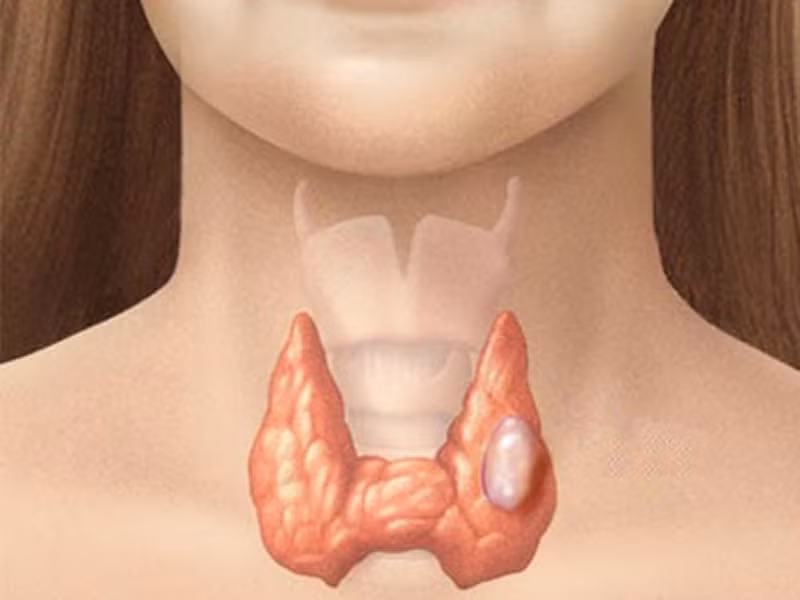 Nắm bắt được nguy cơ mắc bệnh. Việc có người thân từng mắc ung thư tuyến giáp là yếu tố khiến các thành viên khác có nguy cơ mắc bệnh cao hơn so với những đối tượng khác. Ngoài ra, việc tiếp xúc với bức xạ nhiều lần khi còn nhỏ cũng khiến bạn dễ đối diện với căn bệnh.