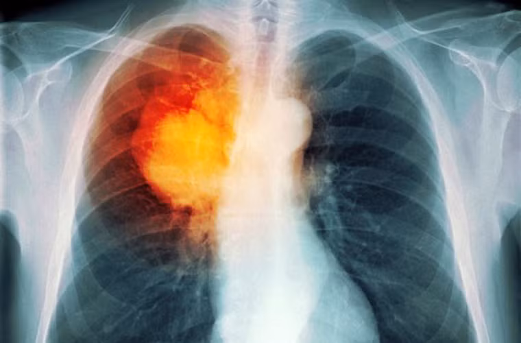Người Mỹ gốc Phi là đối tượng dễ bị ung thư phổi tấn công hơn cả so với các nhóm người khác.
