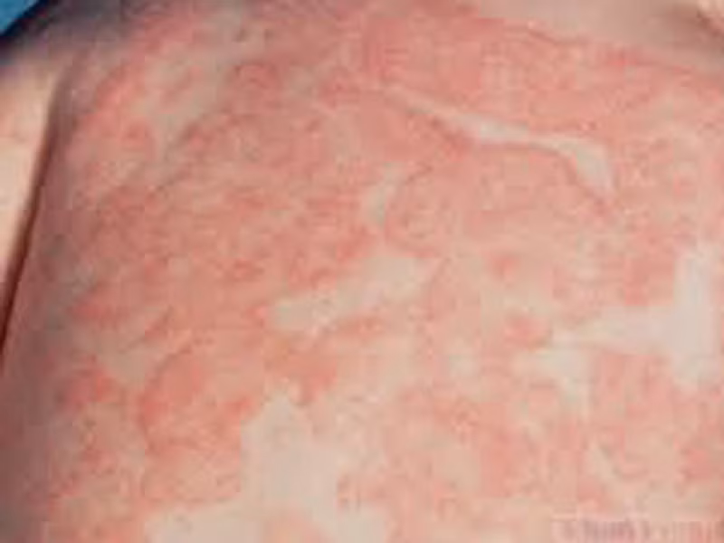 Xuất hiện nốt phát ban và các bản vá lỗi trên da. Bạn cần đặc biệt chú ý khi những nốt phát ban này xuất hiện kèm các triệu chứng khác như sốt, đau khớp, đau cơ. Rất có thể, chúng là dấu hiệu của tình trạng nhiễm trùng.