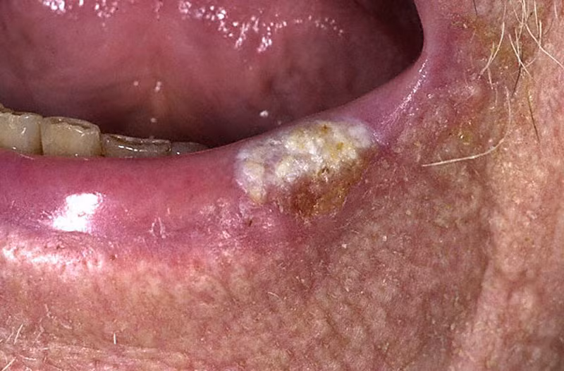 Ngoài ra, những đối tượng có người thân từng mang bệnh cũng dễ mắc ung thư miệng hơn so với các đối tượng khác.