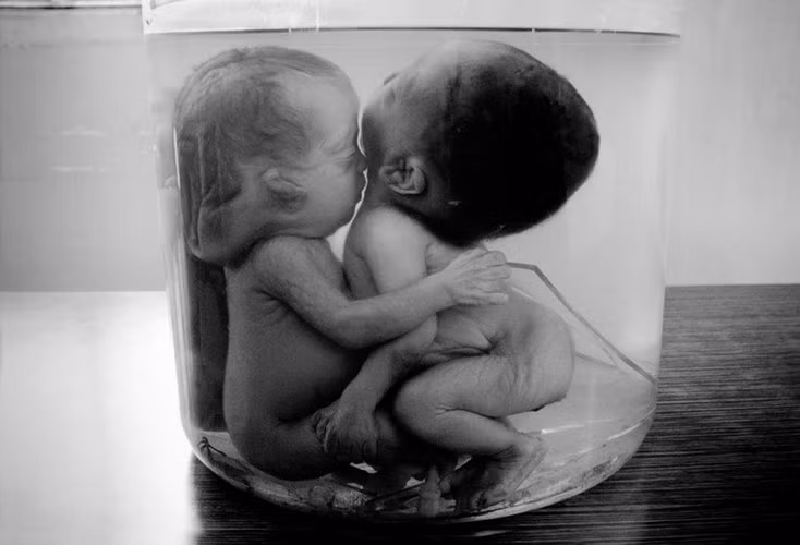 Chất độc Da cam được phát triển từ những năm 1940 để diệt cỏ, đã được quân đội Mỹ sử dụng rộng rãi trong chiến tranh Việt Nam mà không nhận ra những hiểm họa sức khỏe khôn lường của hóa chất này. Một nửa thế kỷ sau cuộc chiến, chất độc Da cam vẫn khiến hàng trăm nghìn người Việt phải sống trong tàn phế và bệnh tật. Ảnh: Philip Jones Griffiths.