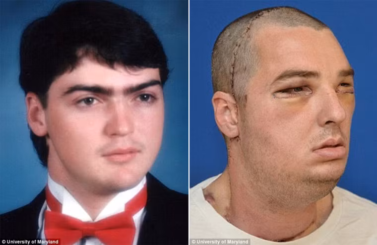 Đến tháng 3/2012, anh được một nhóm gồm 100 bác sĩ tại Trường Đại học Maryland tiến hành phẫu thuật ghép mặt. Cuộc phẫu thuật kéo dài 36 tiếng và rất thành công với khuôn mặt đã khá hoàn chỉnh so với trước, Norris cũng đã lấy lại khứu giác sau cuộc phẫu thuật.