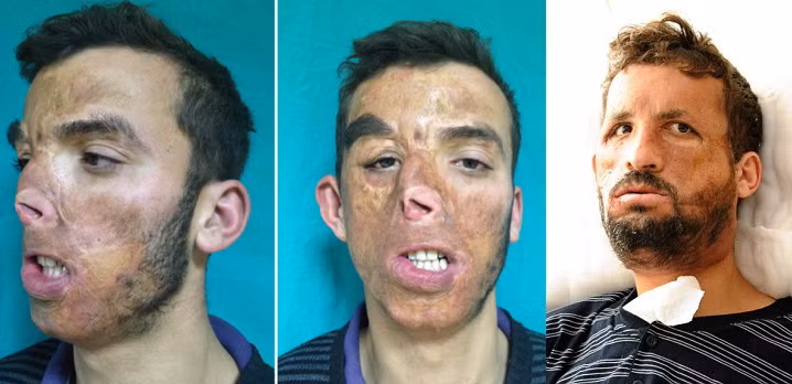 Ugur Acar, 19 tuổi, ở Thổ Nhĩ Kỳ đã bị bỏng nặng sau vụ cháy nhà lúc mới được 40 ngày tuổi. Ugur đã qua vài lần phẫu thuật thẩm mỹ để sửa lại khuôn mặt và tới năm 2012, các bác sĩ ở bệnh viện trường đại học Y Akdeniz đã tiến hành ghép mô từ một người hiến 45 tuổi cho Ugar.