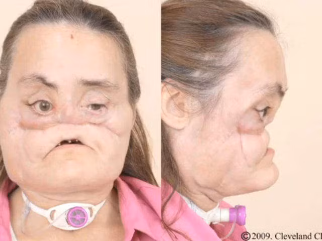 Năm 2008, bệnh nhân người Mỹ đầu tiên ở Mỹ được phẫu thuật ghép mặt là Connie Culp ở Ohio. Người phụ nữ 48 tuổi đã bị chồng bắn vào mặt sau một cơn cuồng nộ và toàn bộ môi trên, mũi, vòm miệng, một bên mắt, hai bên má bị phá hủy hoàn toàn.