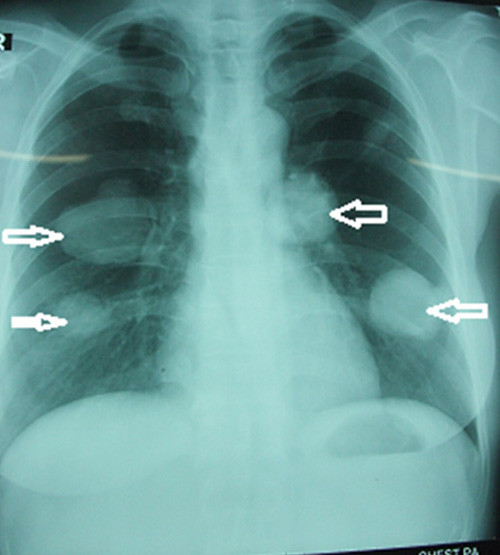 Kết quả chụp X-quang của chị Cẩm Thị H. có 4 khối u khổng lồ trên phổi, mỗi bên có 2 u.