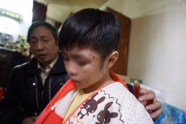 Bé Nam bị bạo hành, trên cơ thể vẫn nguyên nhiều vết thương.