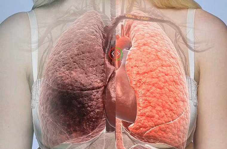 Trái lại, ung thư phổi không phải tế bào nhỏ phát triển chậm, phổ biến và thường gặp ở người không hút thuốc. Đây là loại ung thư ít xâm lấn hơn. Loại ung thư này nếu phát hiện sớm, tiến hành phẫu thuật, xạ trị hay hóa trị kịp thời có thể dễ dàng được chữa khỏi.