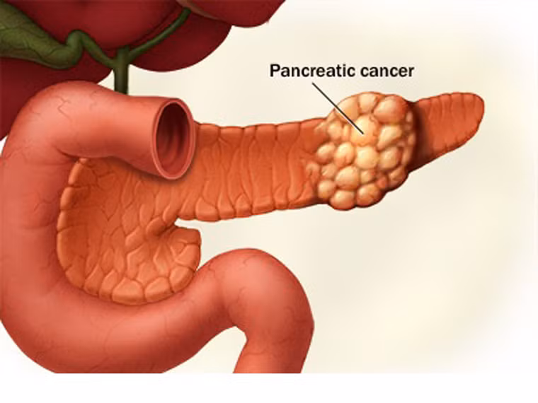Nắm được các yếu tố gây ung thư. Những người có thói quen hút thuốc lá, nghiện rượu, hệ miễn dịch yếu hoặc có thân nhân từng mắc bệnh… dễ đối diện với nguy cơ ung thư hơn nhiều. Chính vì vậy nếu thuộc nhóm này, bạn nên thường xuyên thăm khám để phát hiện dấu hiệu bất thường.