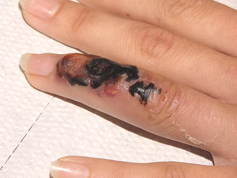 Trong lịch sử, bệnh than đã từng gây ra đại dịch chết chóc kinh hoàng hồi thế kỷ 14. Nạn dịch này khi đó khiến dân số châu Âu giảm một lượng lớn.