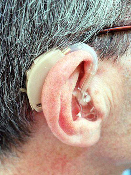 Nếu không được điều trị tốt, trẻ mắc viêm amidan, viêm tai dễ đối diện tình trạng mất thính lực sau này.