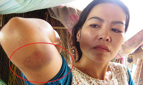 Vết thâm tím trên cánh tay chị Quyên mà theo chị là do bị công an xã đánh khi bị còng tay.