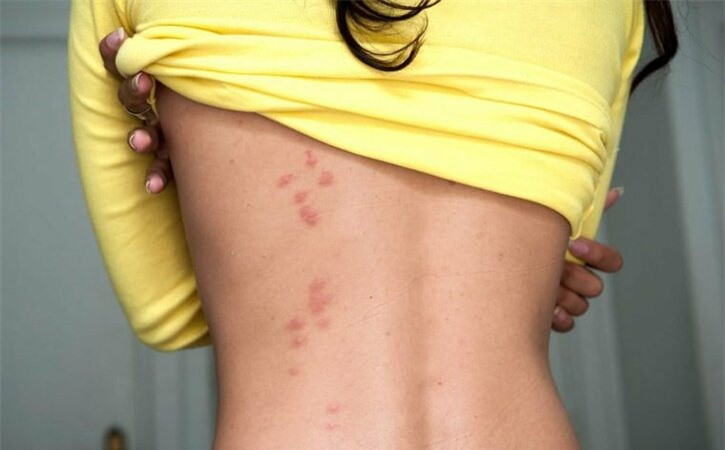 Phát ban: Tâm lý căng thẳng quá mức trong khoảng thời gian dài sẽ khiến hệ thống miễn dịch trở nên suy yếu. Khi cơ thể không kịp giải phóng amin sinh học mang tên histamine để chống lại bệnh tật, da bạn sẽ bị mẩn đỏ, phát ban hoặc bị ngứa.