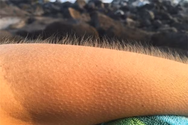 1. Vì sao chúng ta lại có hiện tượng nổi da gà? Nổi da gà là hiện tượng cơ thể chúng ta đã được thừa hưởng từ tổ tiên loài người xưa kia. Ở động vật, nổi da gà là cơ chế sinh học giúp cơ thể giữ nhiệt khi trời trở lạnh, do nhiệt độ khó phân tán hơn qua lỗ chân lông được bít, hoặc khiến cơ thể bỗng trở nên "to phồng" hơn một chút, để tự vệ khi gặp kẻ thù nguy hiểm. Chẳng phải chúng ta cũng thường nổi da gà khi bị lạnh hay gặp chuyện gì bất ngờ, gây sợ hãi đột ngột hay sao.