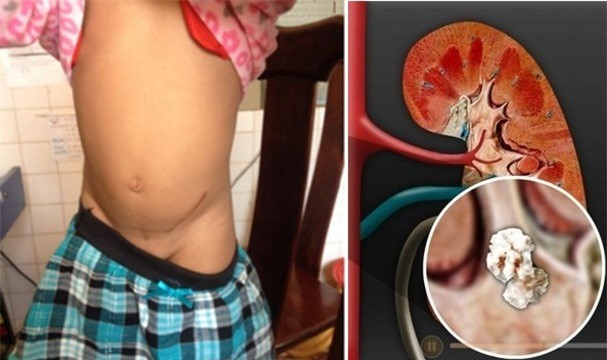 Mẹ khiến con 4 tuổi sỏi thận vì uống nước cam tươi kiểu này Me khien con 4 tuoi soi than vi uong nuoc cam tuoi kieu nay