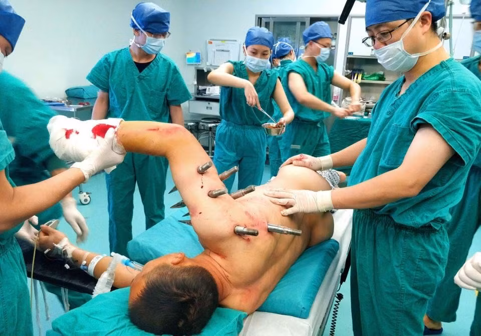 Dang lam viec, bi robot dam 10 chiec dinh thep xuyen nguoi