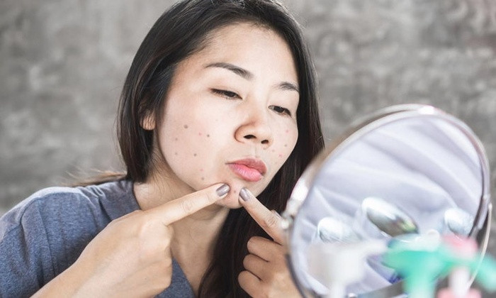 7 thói quen khiến bạn dù đã qua tuổi dậy thì mà mặt vẫn đầy mụn - Hình 2 7 thoi quen khien ban du da qua tuoi day thi ma mat van day mun-Hinh-2